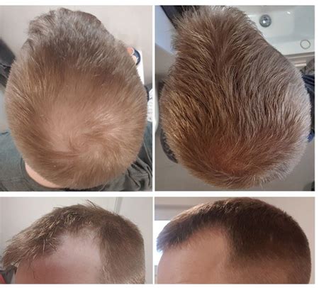 finasteride timeline|Finasteride Before And After: A Results Timeline.
